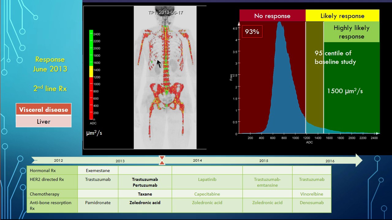 Watching metastatic cancer develop multidrug resistance