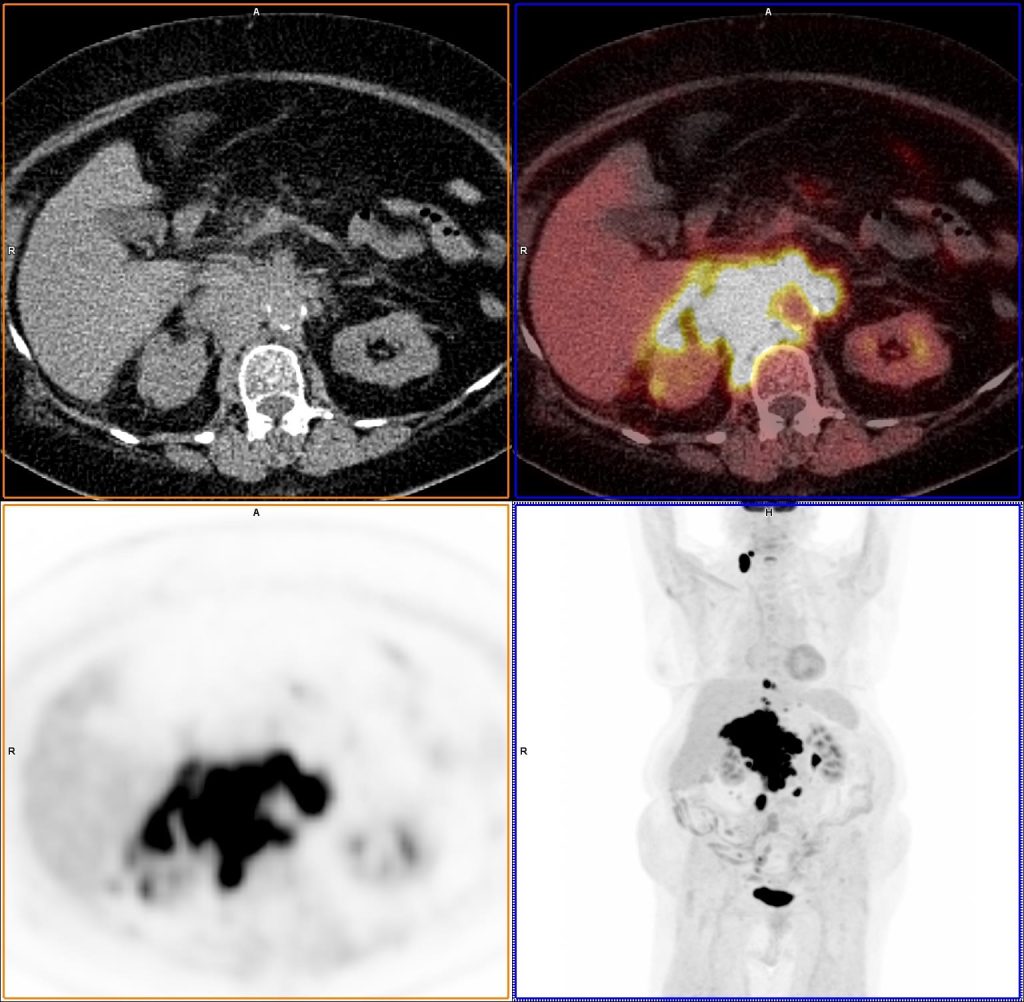 Enlarged Abdominal Lymph Nodes PET-CT image 4