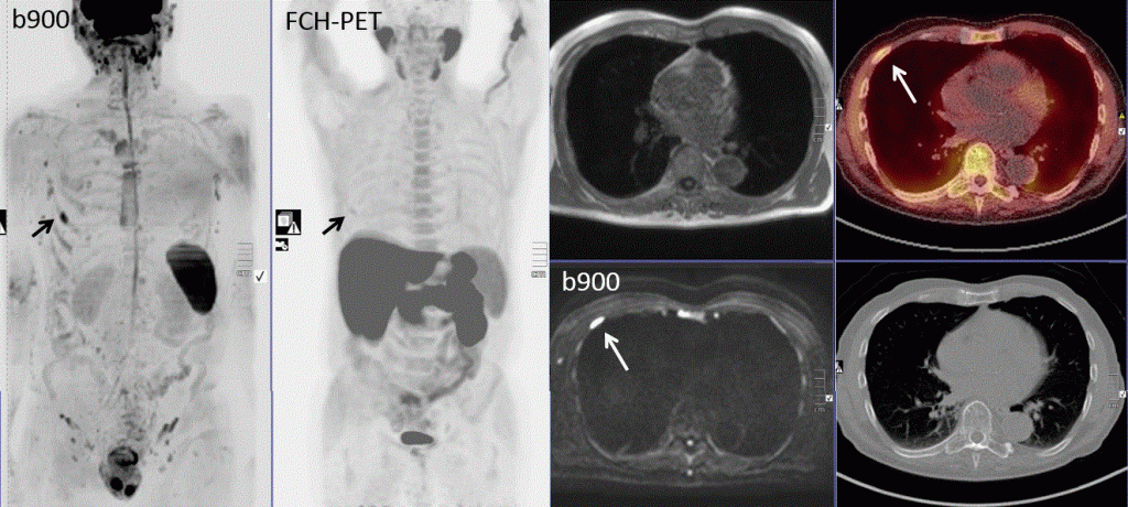 Comparing WB-MRI to Choline PET-CT scan in prostate cancer