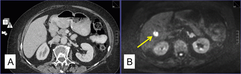 Better performance of MRI compared to CT for liver disease detection in metastatic breast cancer