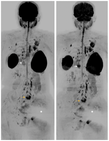 MRI scan