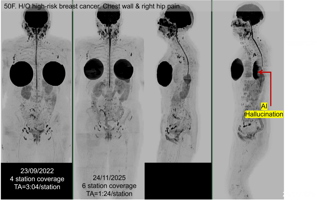 52-year-old woman with high-risk breast cancer
