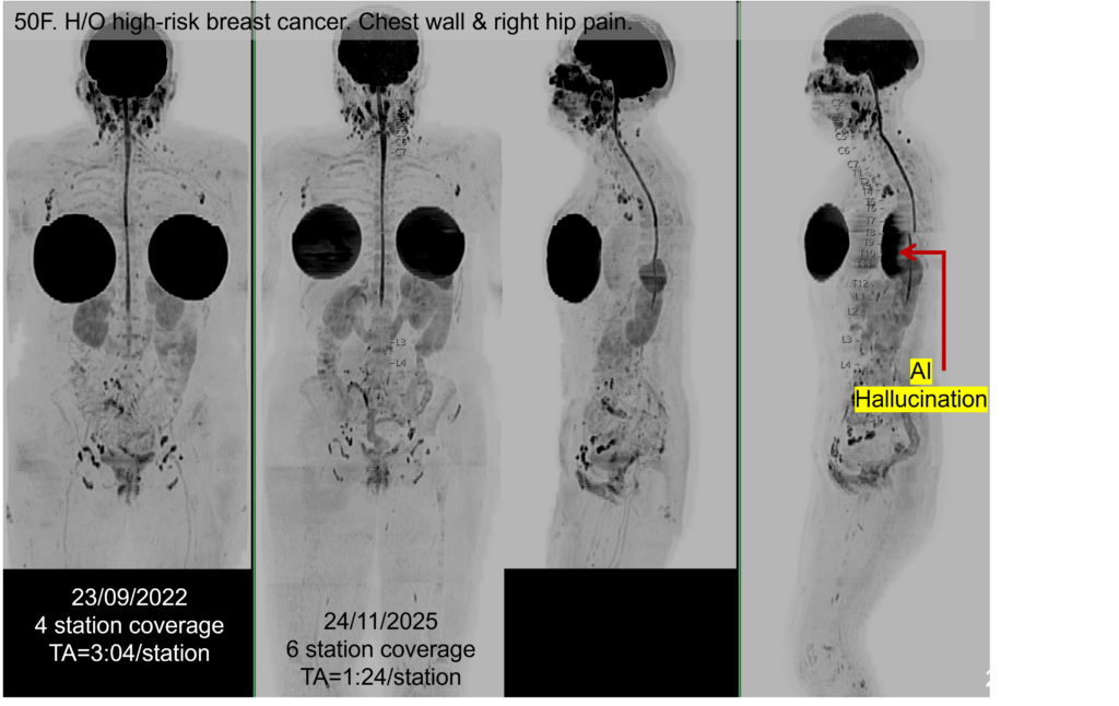 52-year-old woman with high-risk breast cancer
