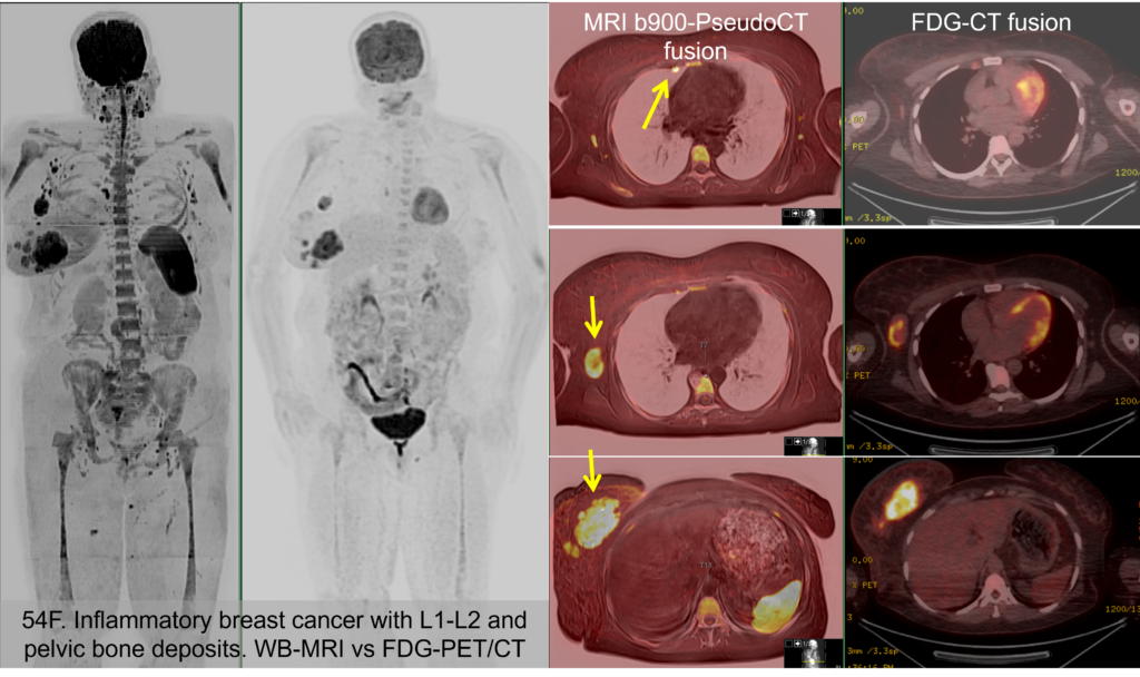 A 54-year-old woman with inflammatory breast cancer and suspected bone disease
