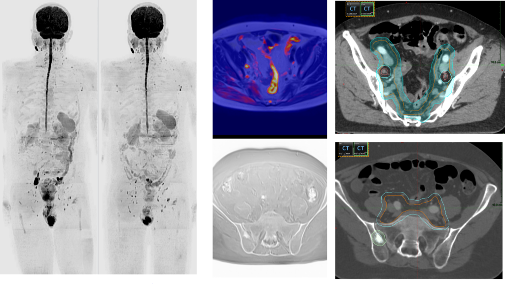 Case 3 – demonstrating the application of NGI-guided radiotherapy
