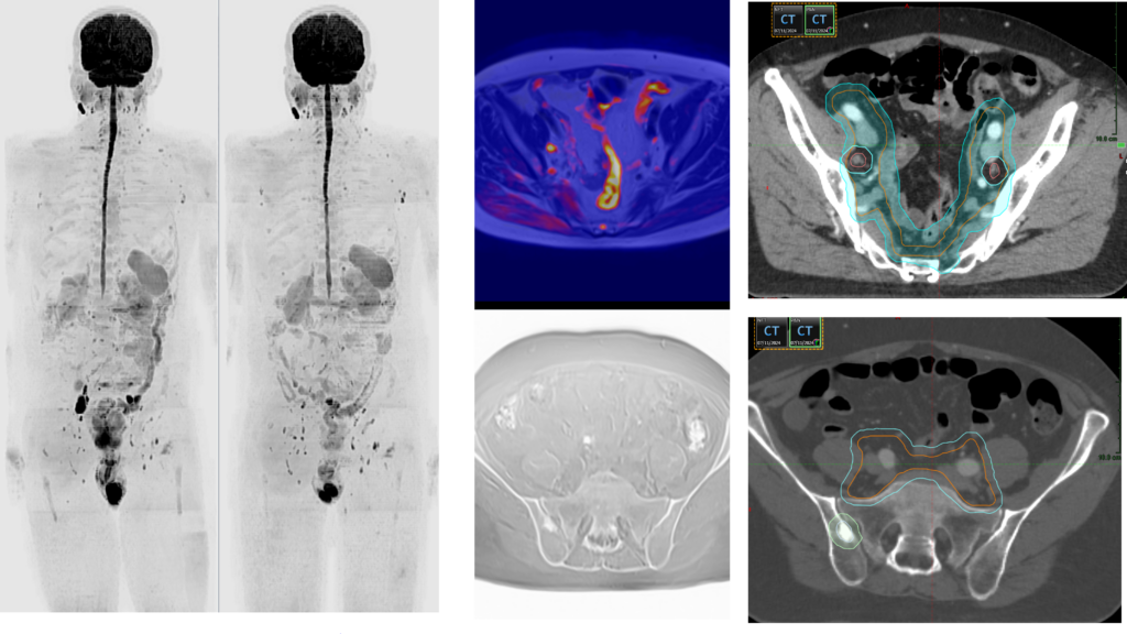 Case 3 – demonstrating the application of NGI-guided radiotherapy