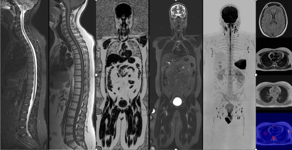 Whole-body MRI