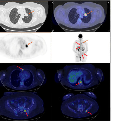 PET-CT Case Study Lung Cancer Case