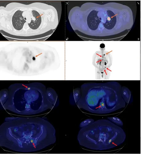 PET-CT Case Study Lung Cancer Case